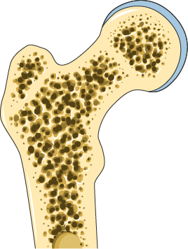 U osteoporózy nejde jen o množství kostní hmoty. Mění se i vnitřní struktura kosti, a tím její odolnost vůči zatížení.
Zdroj obrázku: Servier Medical Art, CC BY 4.0.